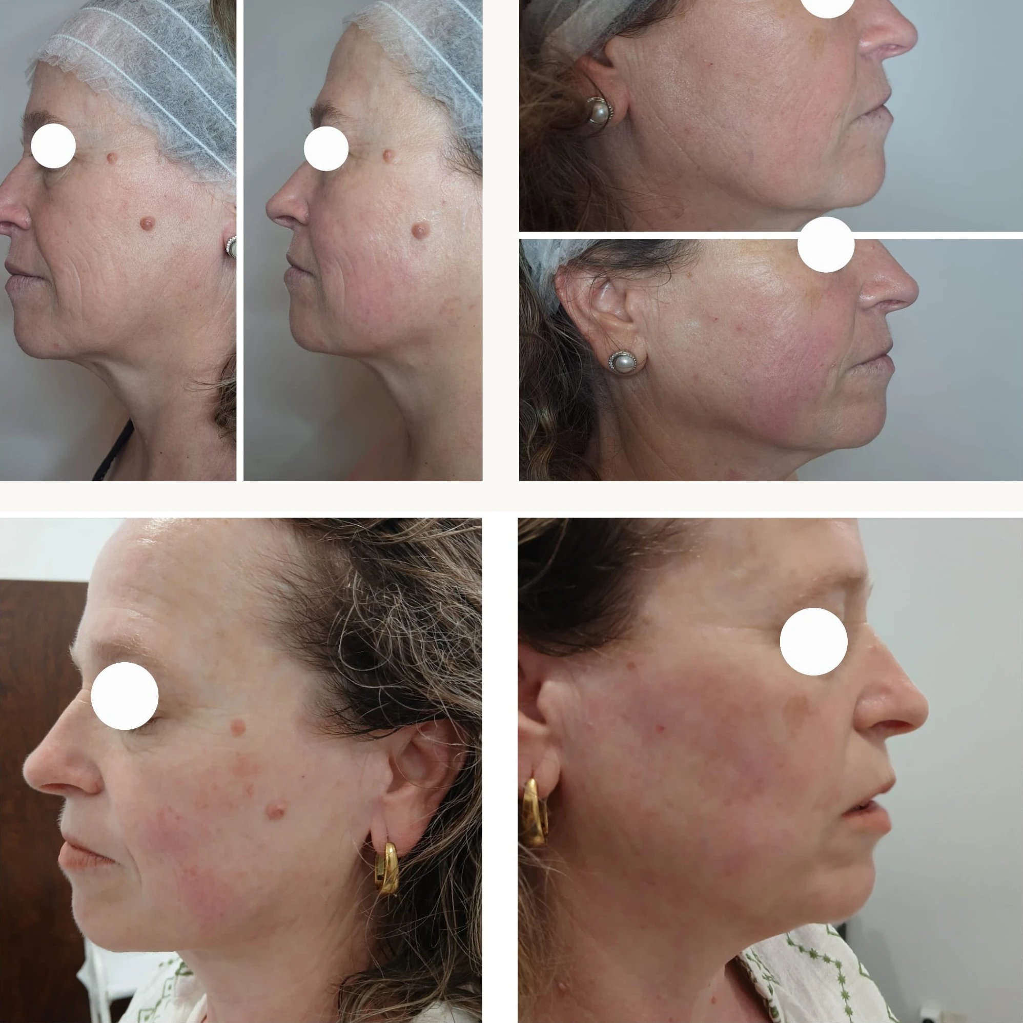 Antes e Depois Hifulifting Pro