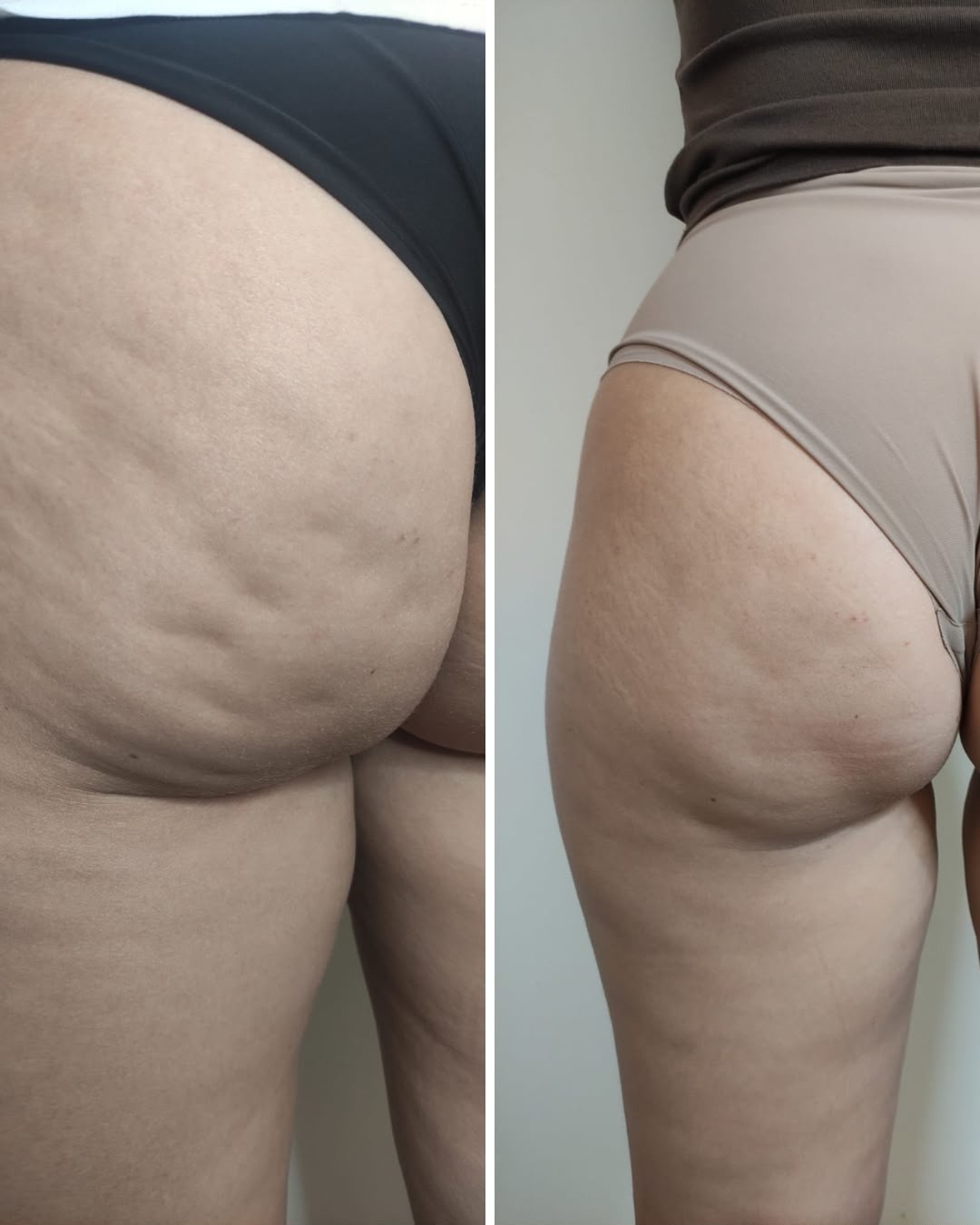 Antes e Depois Therawave Plus