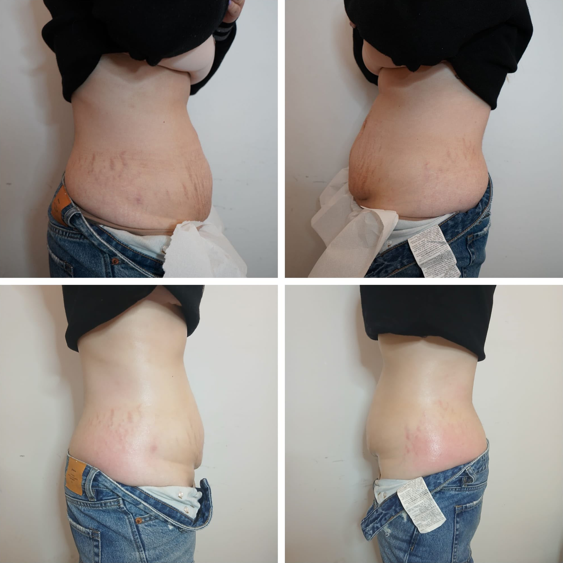 Antes e Depois Lipozero